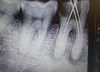 Dental X-ray of a treated root canal at Guarantee Specialist Dental Clinics