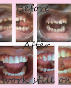 Before and after photos of a patient's restorative dental treatment